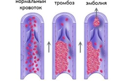 Сърце байпас хирургия процеса съдови усложнения, резултатите