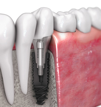 Sistem de implantare dentară a biotechului din Franța - furnizarea de implanturi dentare - sistem