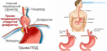 Csúszó hiatus hernia (csúszás) Csúszó hiatus hernia