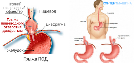 Alunecând hernia deschiderii esofagiene a diafragmei