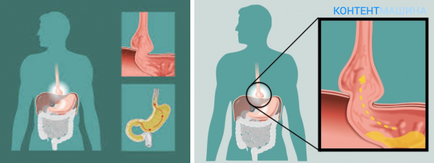 Csúszó hiatus hernia (nyelőcső) Csúszó hiatus hernia
