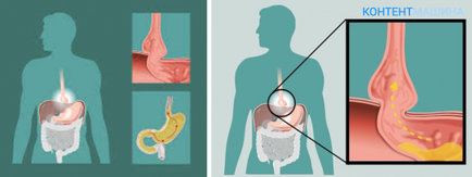 Alunecând hernia deschiderii esofagiene a diafragmei