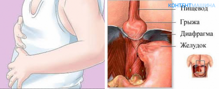 Alunecând hernia deschiderii esofagiene a diafragmei