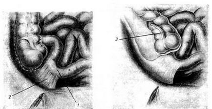 Apendicele orb și vermiform - stadopedia