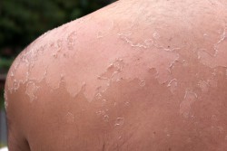 Сонячний опік шкіри лікування народними засобами в домашніх умовах