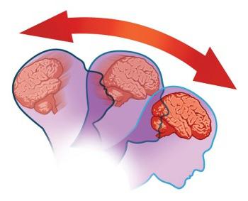Semne de contuzie a creierului și metode de tratament
