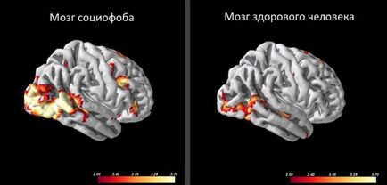 Fobia socială cauzează, simptome, tratament, cum să depășească independent fobia socială