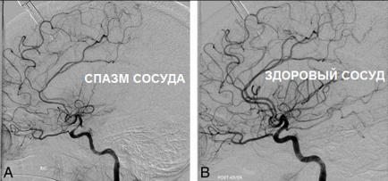 Spasmul vascular