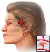 Spasmul vascular