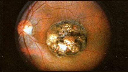 Токсоплазмоз очей фото, симптоми у людини, лікування, класифікація