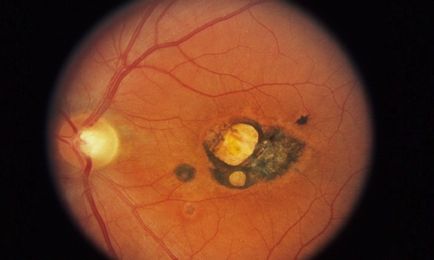 Toxoplasmoza fotografiei oculare, simptome la om, tratament, clasificare