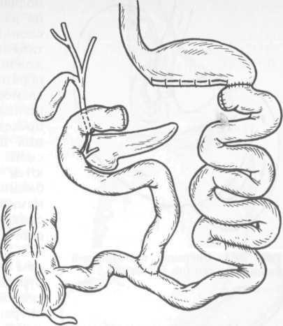 Transplantul intestinului subțire 1