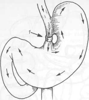 Transplantul intestinului subțire 1