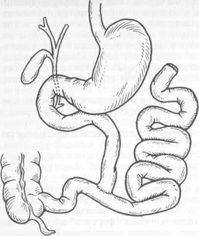 Transplantul intestinului subțire 1