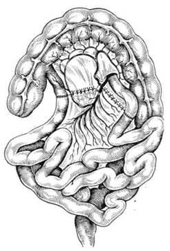 Transplantul intestinului subțire