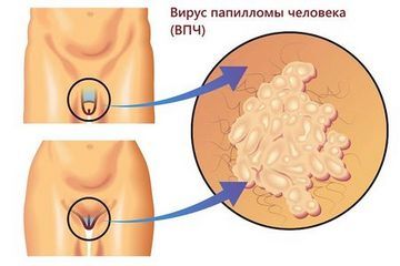 Crăpături în tratamentul mucoasei perineale - frumos la modă