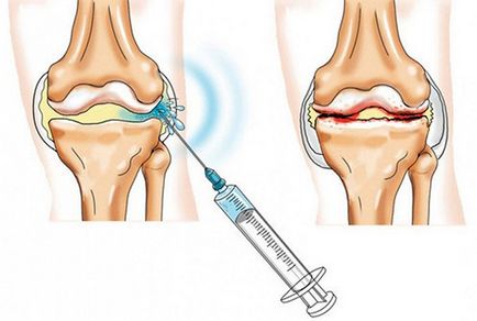 Injecții cu artroză de descriere a preparatelor din genunchi, șold, gleznă