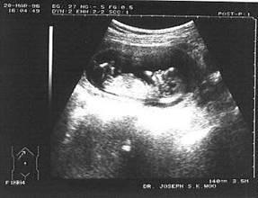 Diagnosticul ultrasonic în obstetrică