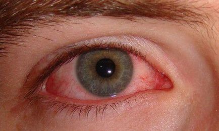 Uveita cauze, simptome, ochi fata, remedii populare, periferice,