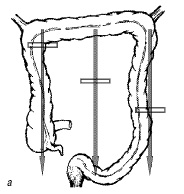 Screening Uzi de cancer de colon - pimani cu