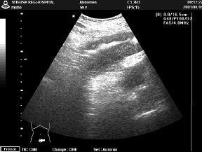 Screening Uzi de cancer de colon - pimani cu