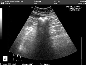 Screening Uzi de cancer de colon - pimani cu