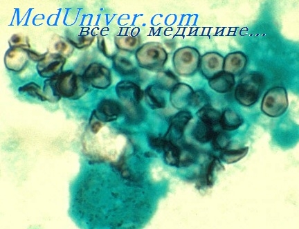 A zsigeri toxocariasis - szindróma Wandering lárvák (Loiasis) A zsigeri toxocariasis - szindróma vándor lárvák