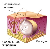 Запалився жировик що робити, як лікувати