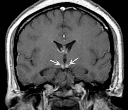 Medicament de Est pentru tratamentul hipertensiunii arteriale