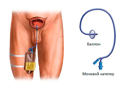 Posibile consecințe ale îndepărtării adenomului prostatic