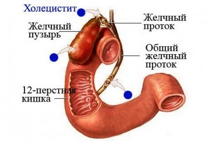 Cholecystitis tünetek gyermekeknél, kezelésére, megelőzésére, okozza a betegség