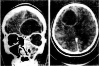 Boli ale nasului și sinusurilor paranazale - primirea medicului de la ORL la Moscova