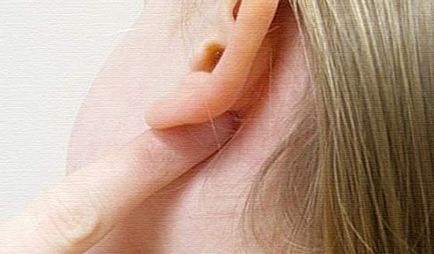 Жировик на мочці вуха що це таке і як швидко вивести без наслідків