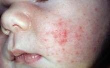 Acneea (acnee) cauze și metode de tratament