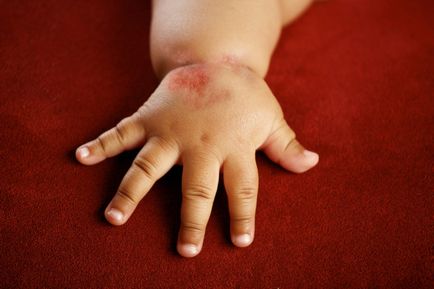 Alergice la simptomele de căpșuni, cauze, tratament, la copii și adulți (foto)