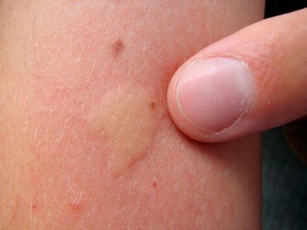 Алергія на укуси комарів у дітей і дорослих - що робити