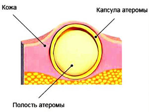 Atheroma az ágyék férfiaknál és nőknél