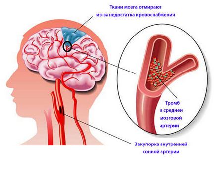 Атеросклероз артерій головного мозку - магістральних, сонних, причини, симптоми, лікування