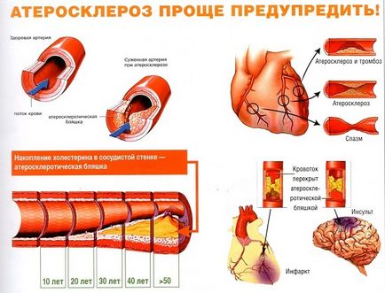 Arterioszklerózis kezelésére népi jogorvoslati