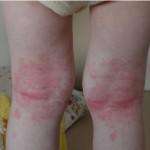 Az atópiás dermatitis gyermekkorban, kezelésére, megelőzésére, okok, diagnózis