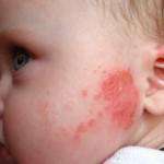 Атопічний дерматит у дітей лікування, профілактика, причини, діагностика