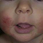 Az atópiás dermatitis gyermekkorban, kezelésére, megelőzésére, okok, diagnózis
