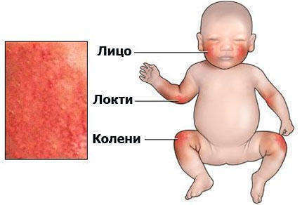 Dermatita atopică în tratamentul copiilor, prevenirea, cauzele, diagnosticul