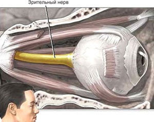 Atrofia cauzelor nervilor optici, simptomelor, diagnosticului, tratamentului