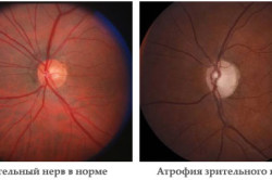 Atrofia nervului optic provoacă, simptome, tratament