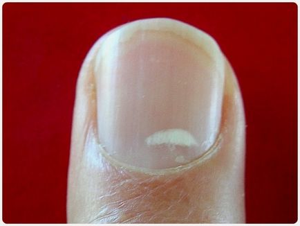 Petele albe pe unghiile copilului cauzează apariția, diagnosticul, tratamentul
