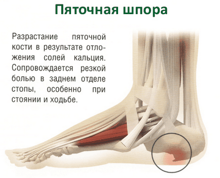 Бішофіт при лікуванні п'яткової шпори і інших проблем