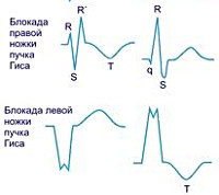 Blocarea picioarelor pachetului de gips - cauze, simptome, diagnostic și tratament