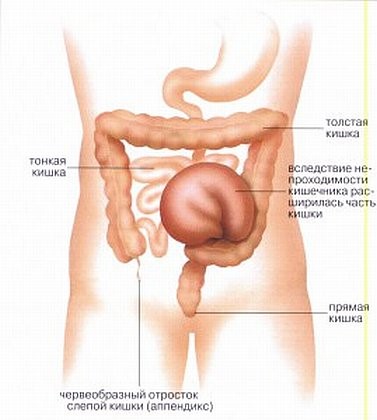 Durerea în intestinul gros provoacă apariția, diagnosticarea bolilor - vii sănătoși