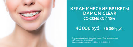 Bretele - instalare de bretele în stomatologie din Kazan - prețuri pentru bretele - dentist